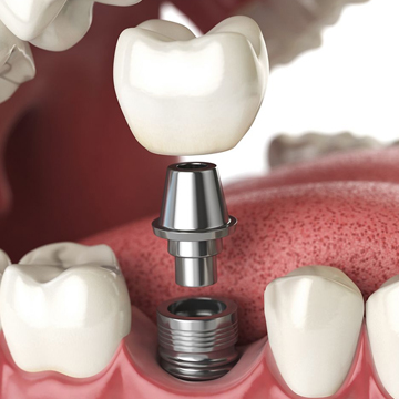 3D image showing the parts of dental implant tooth.