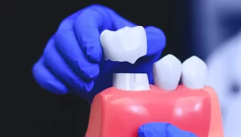 What Makes Dental Crowns Essential for Your Teeth?