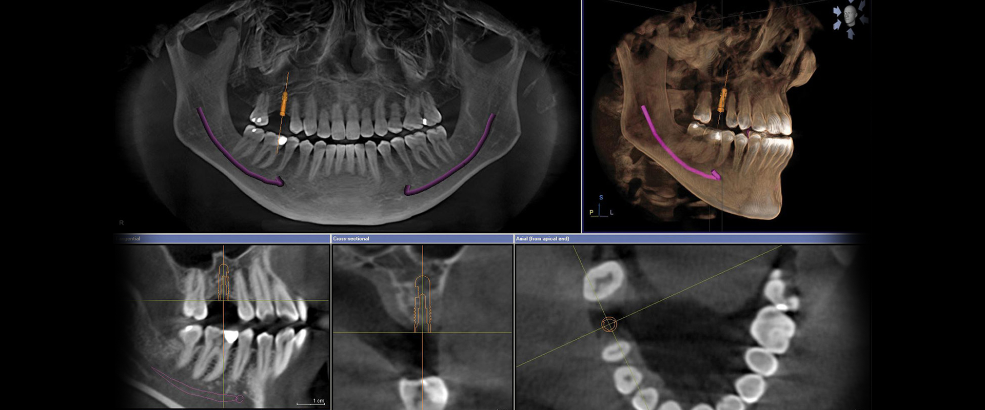 Dental Implants Utilizing State of the Art Technology