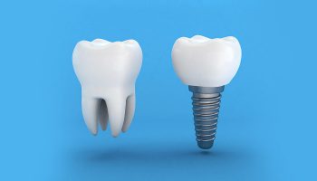 5 Reasons Why Dental Implants Are So Popular in Clearwater, FL