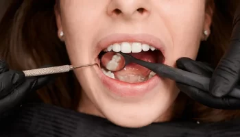 The Connection Between Tooth Decay and Dental Fillings