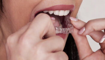 What Are The Advantages of Clear Aligner Therapy?