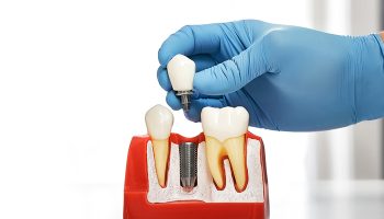 How Do Dental Implants Work? Step-by-Step Overview