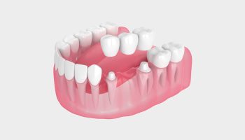 How Dental Bridges Restore Your Smile and Oral Function